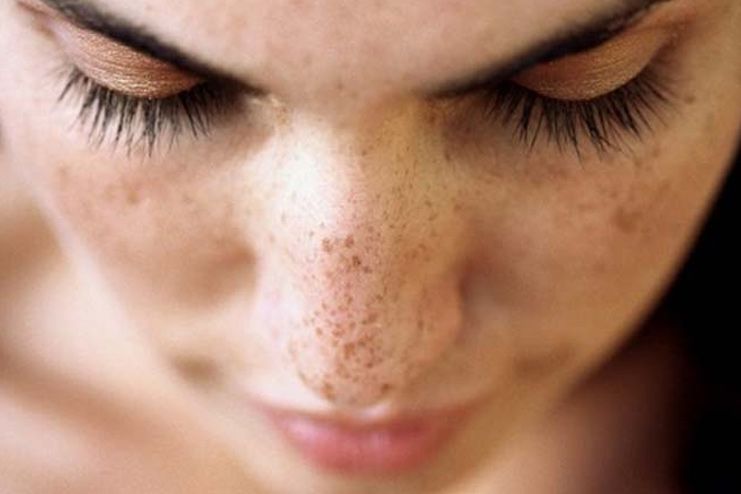 What causes Dark Spots