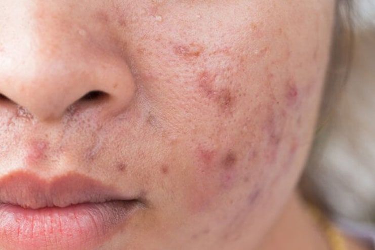 What is Acne Scars