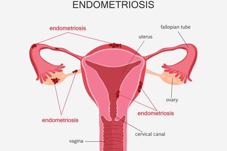 What is Endometriosis