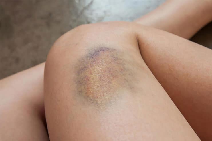 Symptoms of bruises