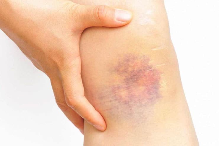 What causes bruises