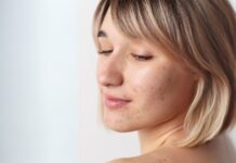 Say Goodbye to Acne and Fade Scars with These 4 Home Remedies Acne and Fade