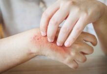 Home Remedies to Treat Skin Rashes Home Remedies to Treat Skin Rashes
