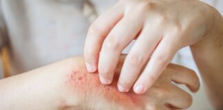 Home Remedies to Treat Skin Rashes Home Remedies to Treat Skin Rashes