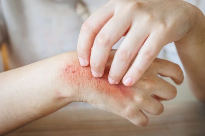Home Remedies to Treat Skin Rashes