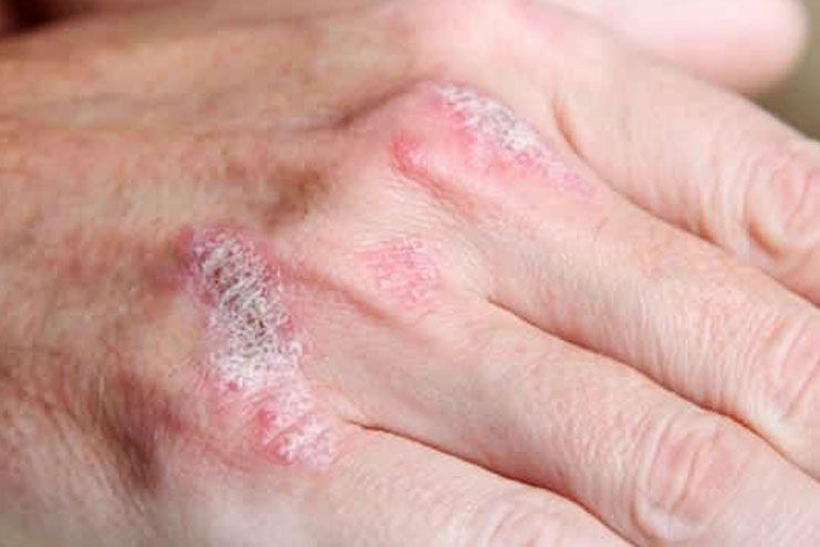 5 Best Foods To Cure Psoriasis