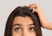 8 Best Home Remedies For Dandruff And Flaking Best Home Remedies For Dandruff