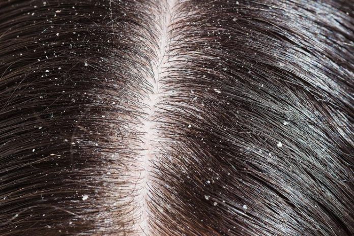 Remedies For Dandruff