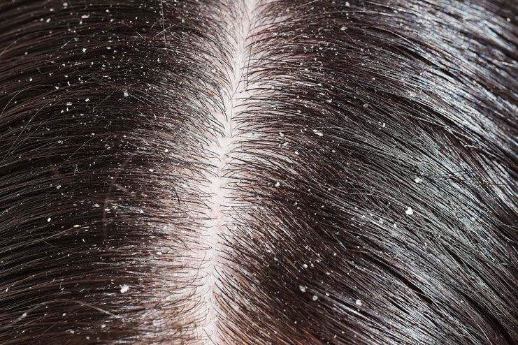 8 Best Home Remedies For Dandruff And Flaking