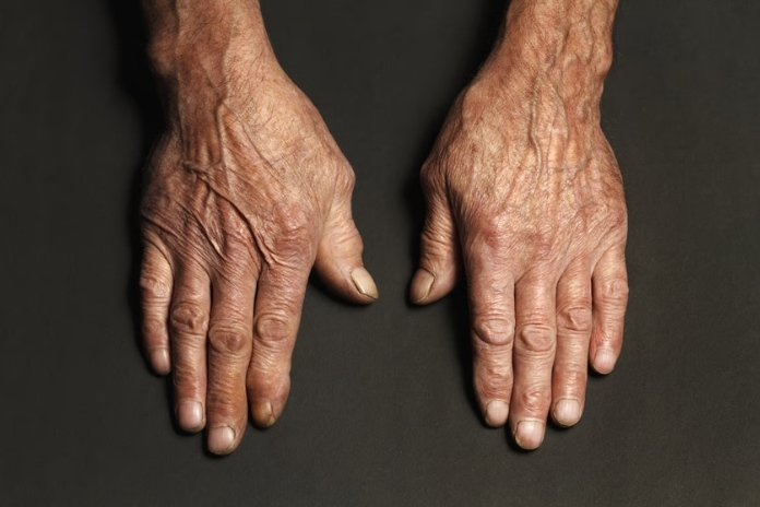 Rheumatoid Arthritis Diet Rheumatoid Arthritis Diet