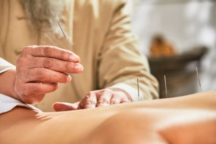 Acupuncture Benefits for Health and Wellness