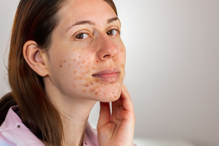 Causes of Acne Scars