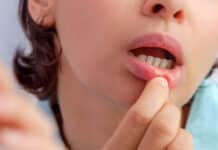Causes of Blood Blister in Mouth and Treatment Causes-of-Blood-Blister-in-Mouth