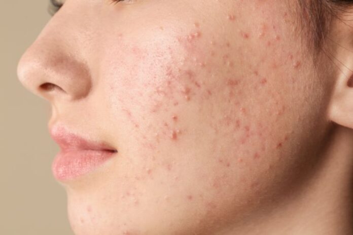 How to Get Rid of Acne Scars at Home