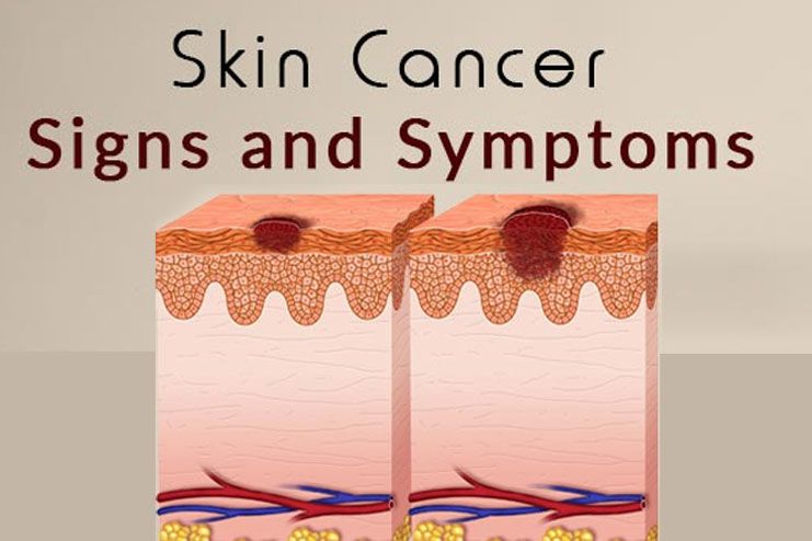5 Early Signs of Skin Cancer