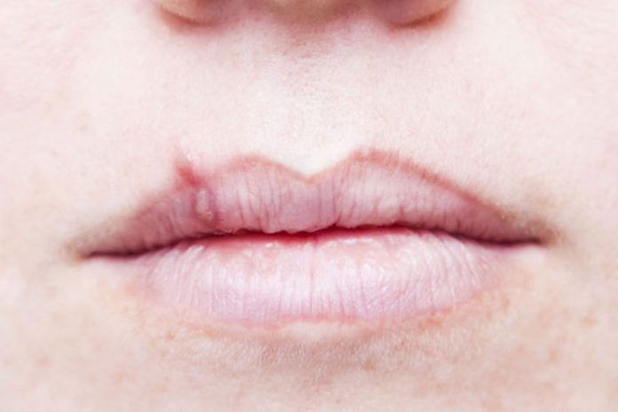 how to get rid of cold sores