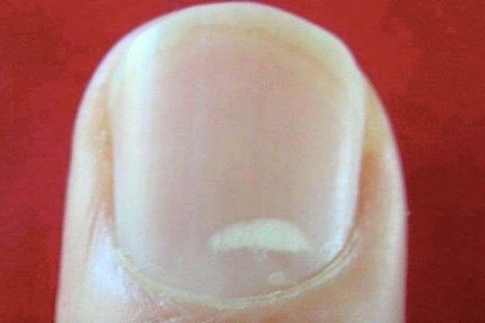 How To Remove White Spots On Nails