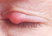 How to Cure a Stye on the Eye Eye Stye