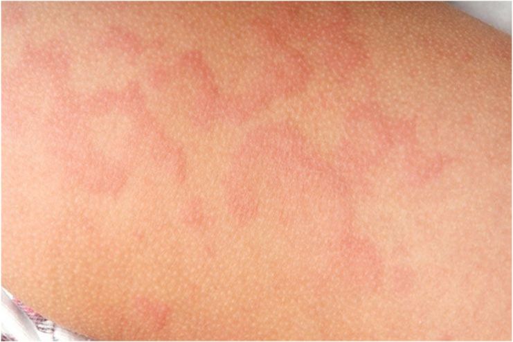 ain Causes of Diaper Rash