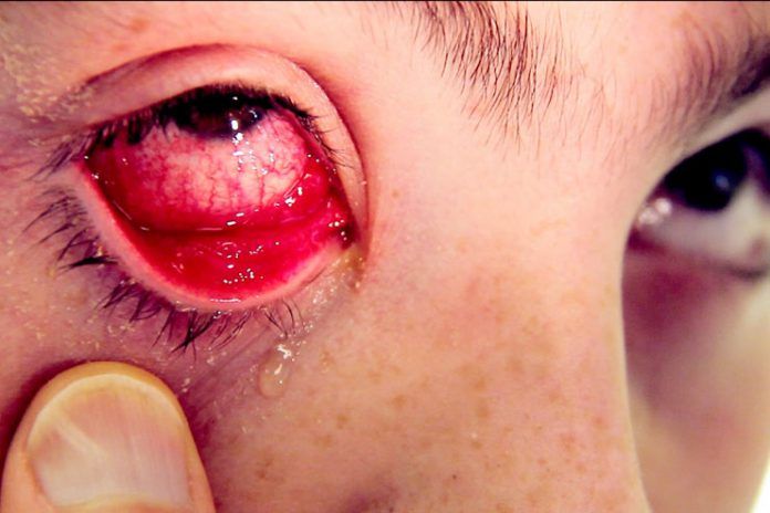 get rid of pink eye