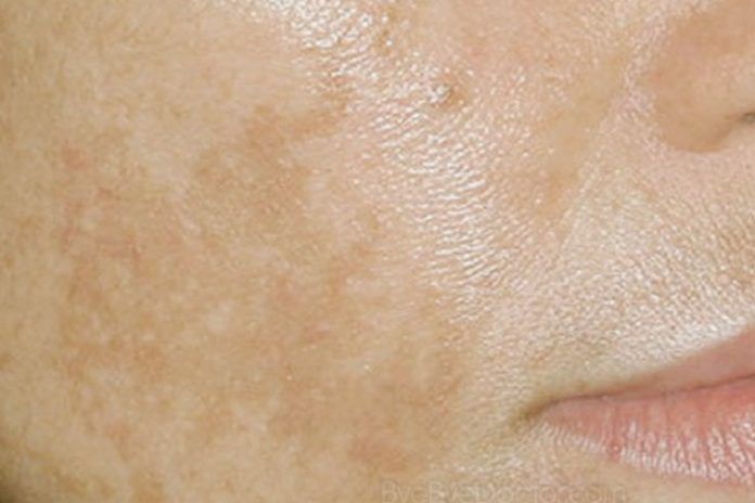 brown spots on face