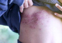 How to Cure Small Itchy Bumps on Skin How-to-Cure-Small-Itchy-Bumps-on-Skin