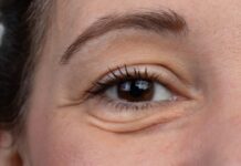 How to Remove Bags Under Eyes How to Remove Bags Under Eyes