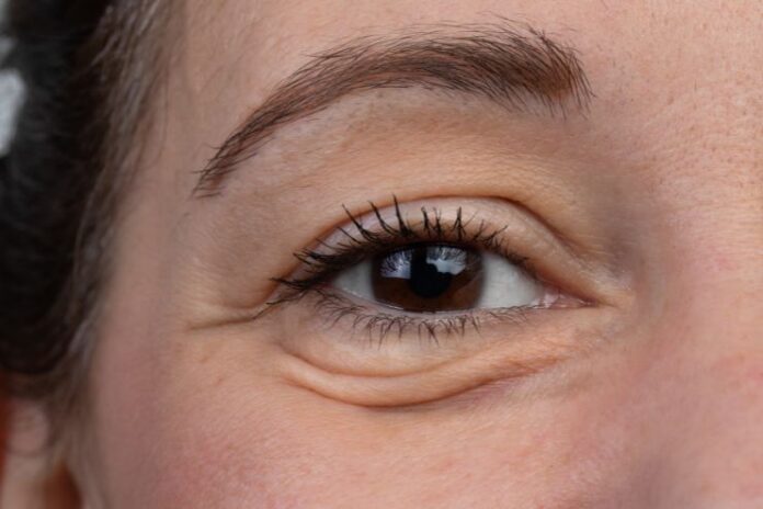 How to Remove Bags Under Eyes