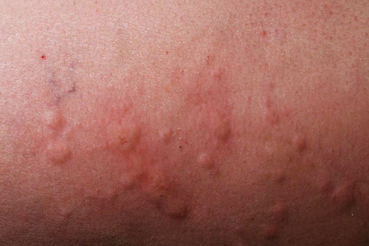 Red Itchy Bumps On Skin Causes Symptoms Pictures Trea