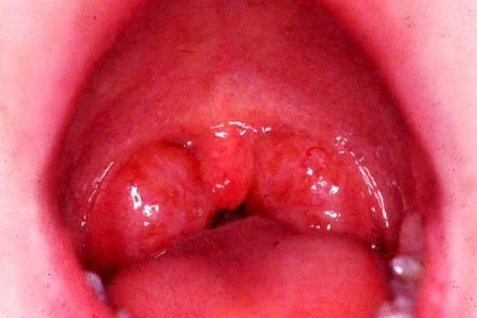 strep throat infection