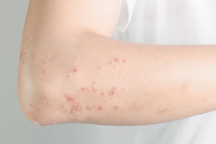 how to get rid of hives