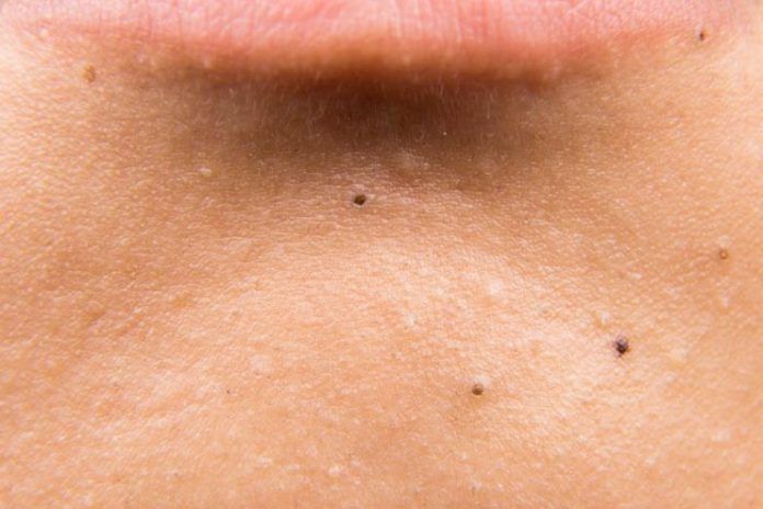 black spots on skin