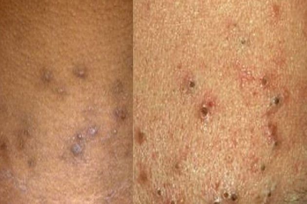How To Get Rid Of Black Spots On Skin how-to-get-rid-of-black-spots-on-skin
