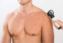 Chest Acne: Causes, Treatment And Prevention Chest Acne Causes Treatment