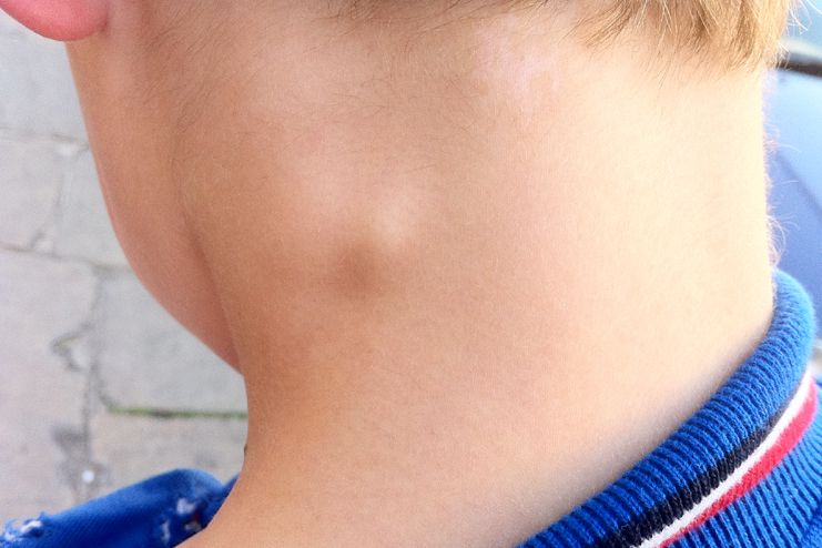 bump behind ear bump behind ear
