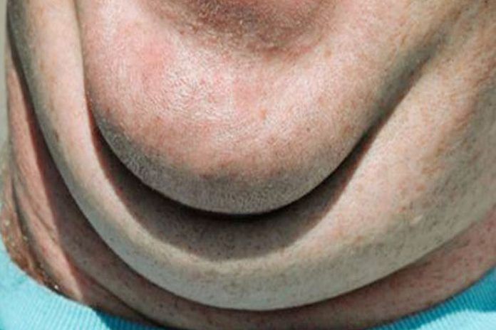 how to get rid of double chin