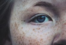 How to Get Rid of Freckles how to get rid of freckles