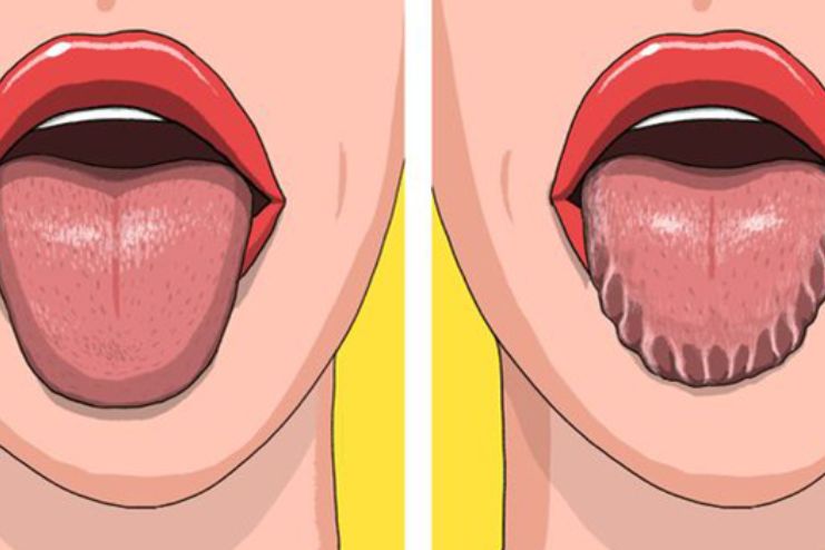 How to Diagnose Wavy Tongue