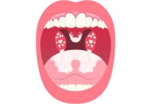 How to Remove White Spots on Throat How to Remove White Spots on Throat