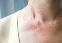 How to Treat a Rash on the Neck How to Treat a Rash on the Neck