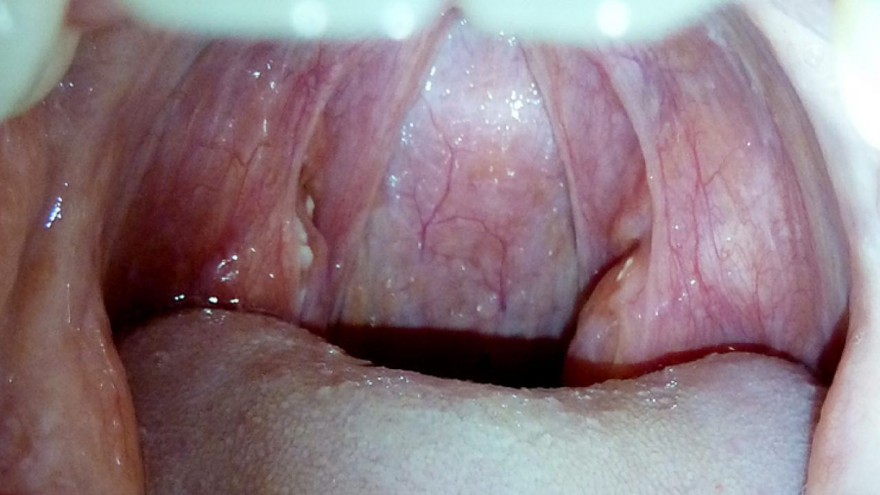 mentalitet Unravel detaljeret How to Remove White Spots on Throat