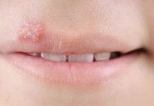 How to Treat Bumps on Lips bumps on lips