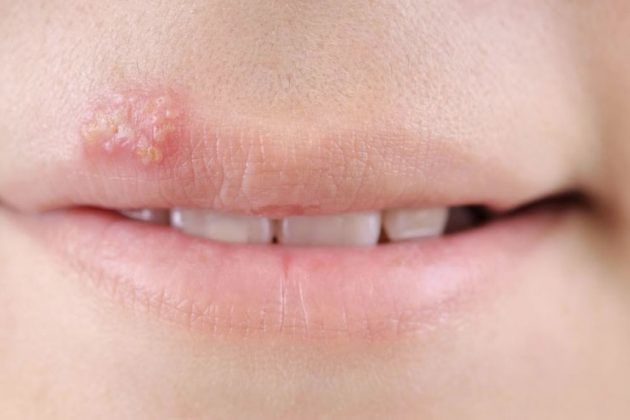 How To Get Rid Of Bumps On Lips