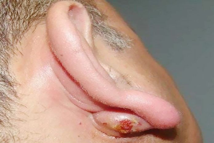 How To Get Rid Of Lump Behind Ear