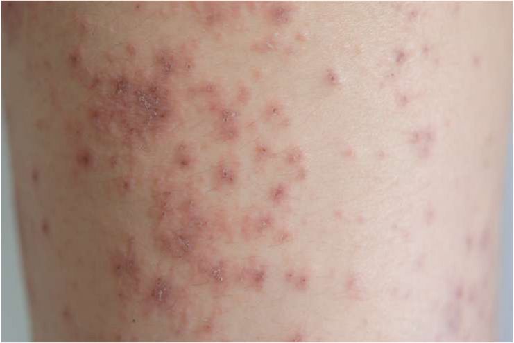 Causes of Rash on Inner Thigh