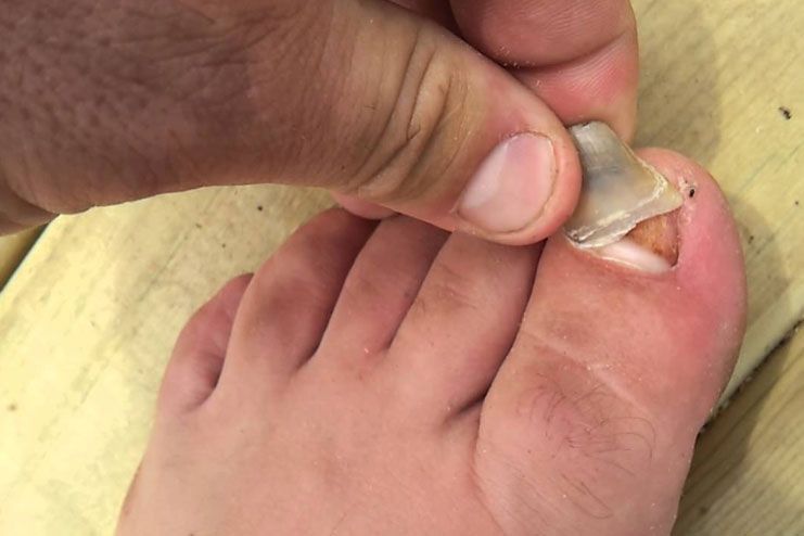 How to Remove Dead Toenails: Causes, Symptoms and Treatment