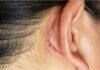 How to Get Rid of Lump Behind Ear How to Get Rid of Lump Behind Ear