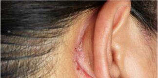 How to Get Rid of Lump Behind Ear How to Get Rid of Lump Behind Ear
