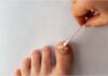 How to Remove Dead Toenails: Causes, Symptoms and Treatment How to Remove Dead Toenails