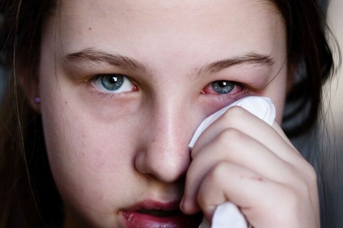 How to Treat a Pink Eye